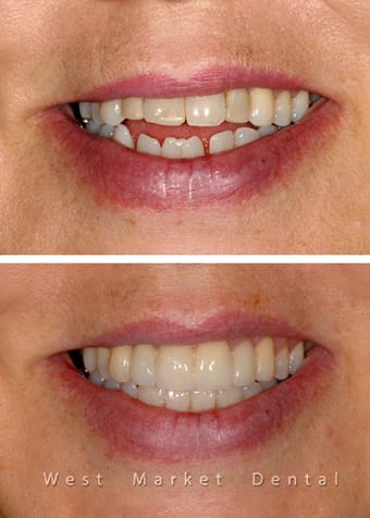 Before and After Cosmetic Treatment | West Market Dental | Calgary Dentist 